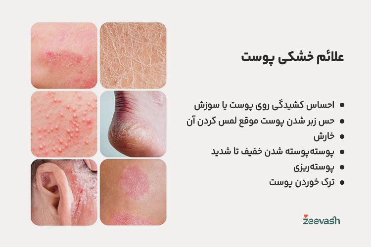 علائم خشکی پوست